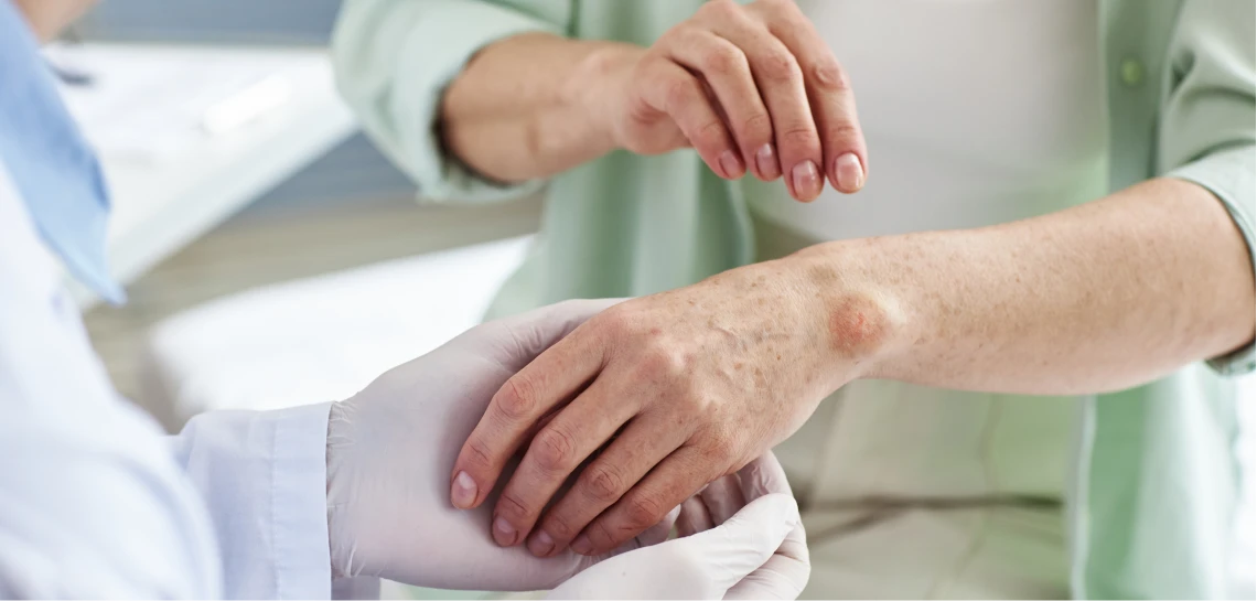 Should I Apply For Scleroderma Disability Benefits?